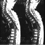 Snímky z MRI: zhoubné nádory páteře Autor: biomed.brown.edu