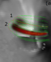 Autor: Galina Motorina - D model dvojice smyček magnetického pole vyplněné plazmatem termálním (vlevo) a netermálním (vpravo) v čase 3:50:28 UT. Linie naznačují tvar siločar magnetického pole, barvy pak prostorové rozložení přehřátého plazmatu nebo netepelných elektronů. Na pozadí jsou zobrazeny polarity fotosférického magnetického pole.