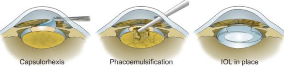 IOL=Intraocular Lens


Jak se provádí operace šedého zákalu?
V minulosti znamenala operace šedého zákalu otevření rohovky a práci přes otvor o velikosti implantátu čočky nebo větší. Dnes lze vše provést přes 2–3 mm řez na boku rohovky. Řez je dostatečně malý, aby se ve většině případů zahojil bez stehů. 
 Prvním krokem je capsulorhexis, otevření přední části pouzdra čočky. Chirurg uvolní chlopeň tkáně pomocí zahnuté jehly, poté ji uchopí pinzetou a protrhne kruhový otvor, podobně jako když protrhujete kruh ze středu kusu papíru.
 Poté chirurg pomocí ultrazvukové sondy rozbije přirozenou čočku (tento postup se nazývá fakoemulzifikace). Kousky se odsají a vloží se náhradní nitrooční čočka, neboli IOL. IOL je složená, aby prošla malým řezem v rohovce; poté se rozloží uvnitř oka a chirurg umístí podpůrné drátky, neboli haptiky, na místo ve zbývajícím pouzdru čočky. Autor: Jerry a Kathy Oltionovi
